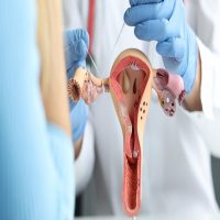 Tubal Ligation Surgery