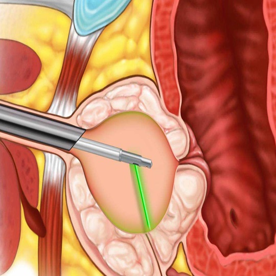 Bartholin Kisti Bartholin Kisti