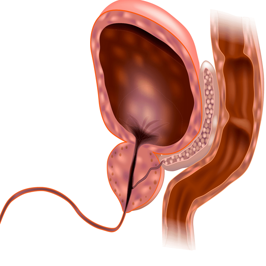 Blasenvorfall Zystozele Operation