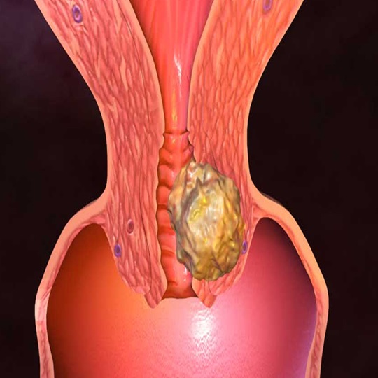 Gebärmutterhalskrebs