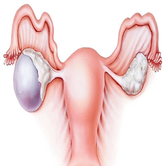Bartholin Kisti Neden Oluşur Bartholin Kisti Neden Oluşur
