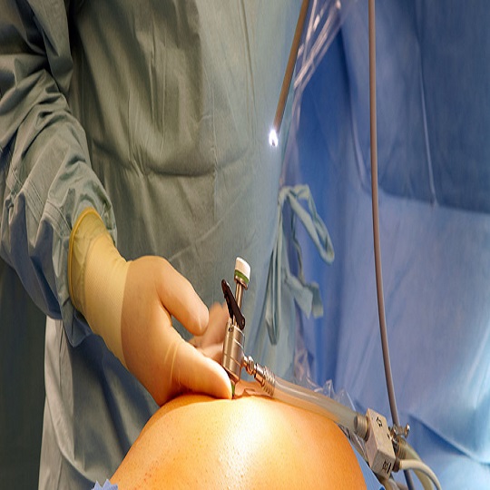 Vajinal Daraltma Ameliyatı Vajinal Daraltma Ameliyatı