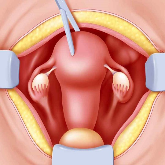Vajinal Gevşekliğin Nedenleri Vajinal Gevşekliğin Nedenleri