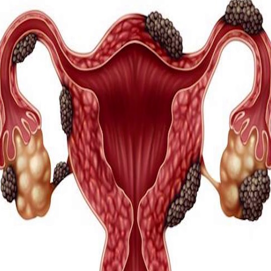 Endometriom Schokoladenzyste