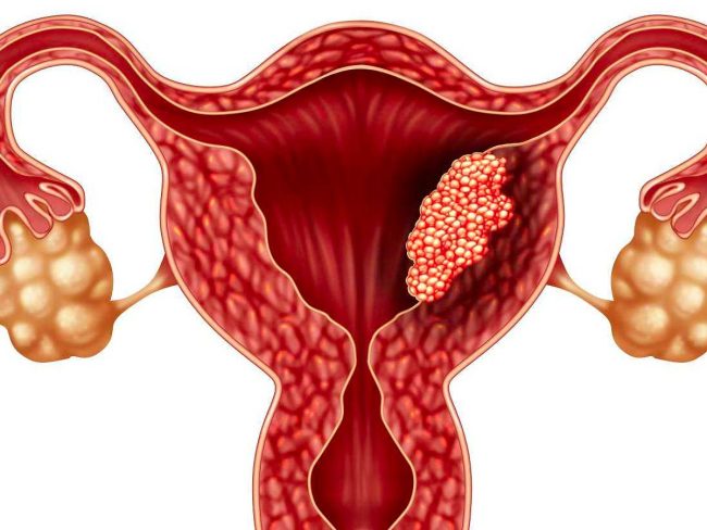 Endometrioma Tedavisi Endometrioma Tedavisi