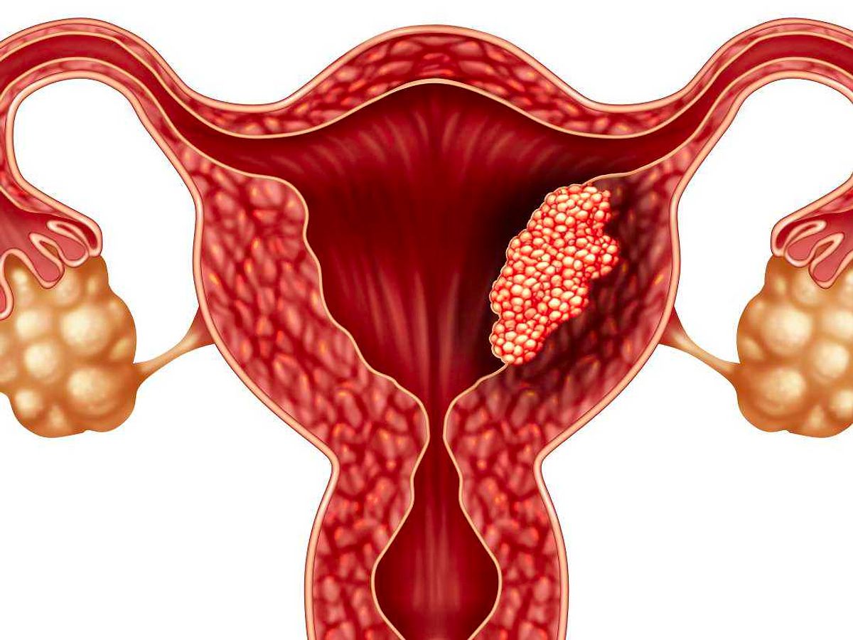 Endometrioma Tedavisi Endometrioma Tedavisi