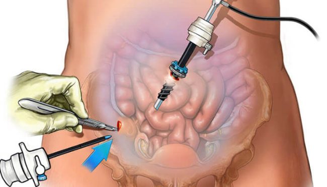 Laparoskopik kist çıkartılması Laparoskopik kist çıkartılması