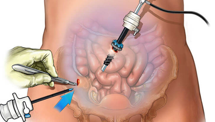 Laparoskopik kist çıkartılması Laparoskopik kist çıkartılması