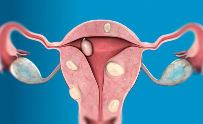 Myom ameliyatı Myom ameliyatı