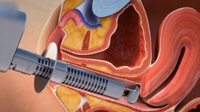 Vajinal Dolgu İstanbul Vajinal Dolgu İstanbul