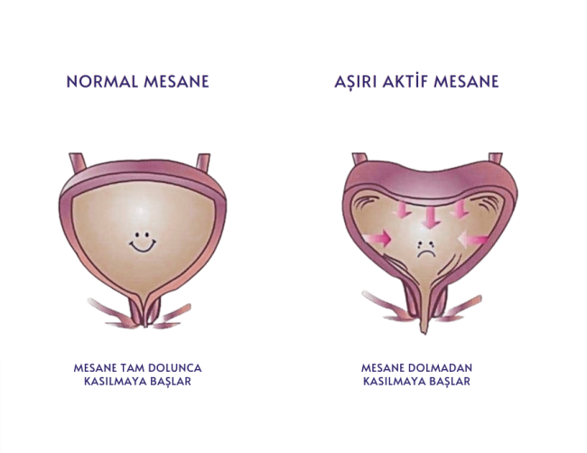Aşırı aktif mesane sendromu nedir?
