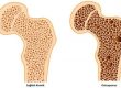 Kemik erimesini osteoporoz önlemek için ne yapmalı?
