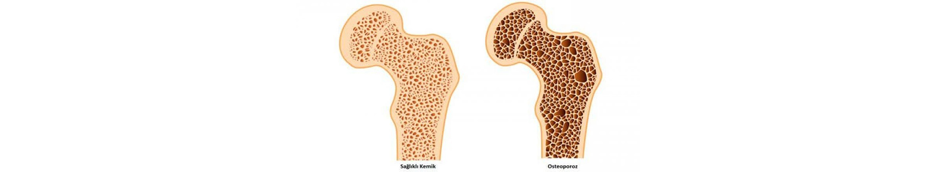 Kemik erimesini osteoporoz önlemek için ne yapmalı? Kemik erimesini osteoporoz önlemek için ne yapmalı?
