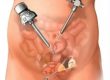 Laparoskopi ile çikolata kisti endometriozis ameliyatı nasıl olur?