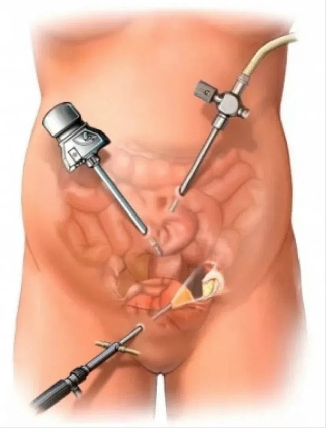 Laparoskopi ile çikolata kisti endometriozis ameliyatı nasıl olur? Laparoskopi ile çikolata kisti endometriozis ameliyatı nasıl olur?